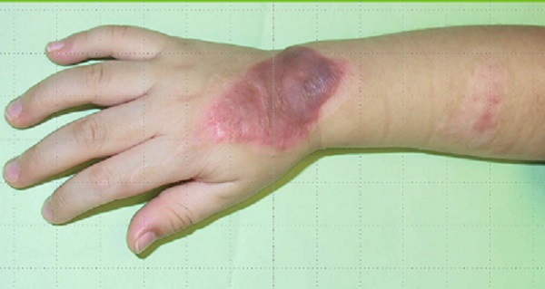 How to Fade Burn Scars Naturally